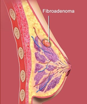 1Excision of Fibroadenoma