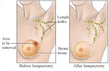 1Lumpectomy