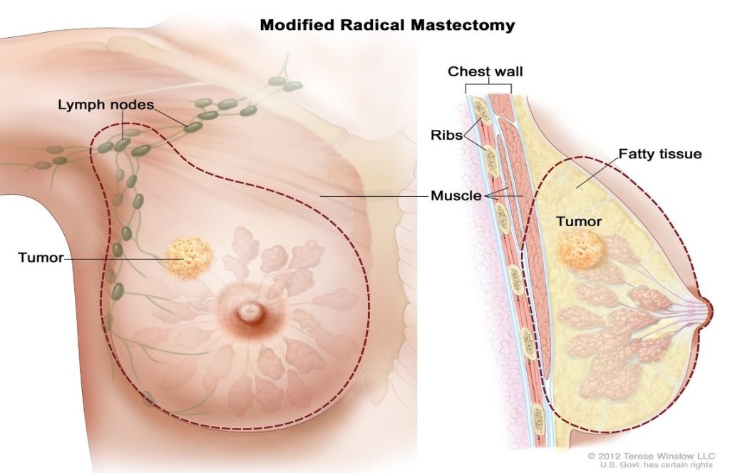 1Mastectomy