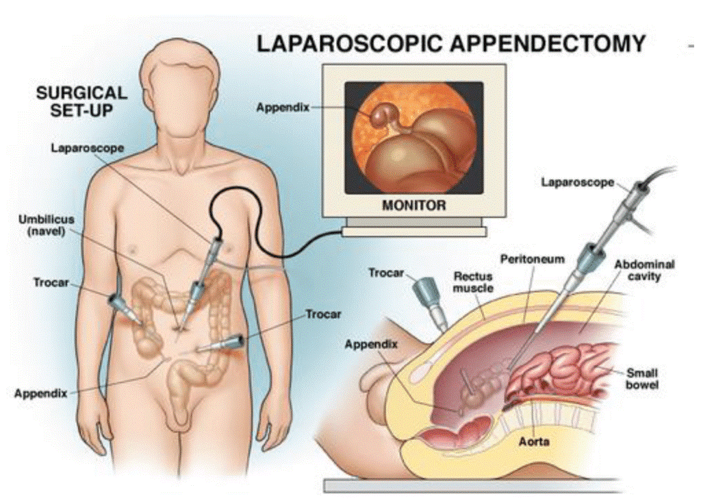 22Appendicectomy