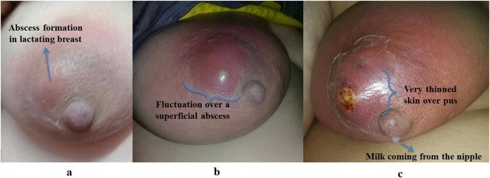 2Drainage of Breast Abscess