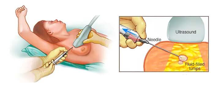 2Excision of Fibroadenoma