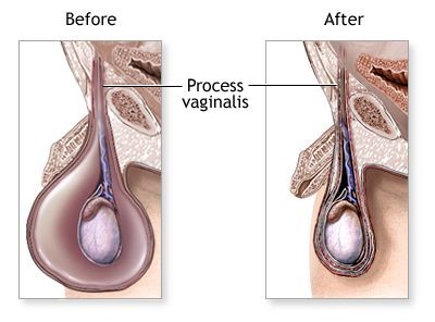 2Hydrocele