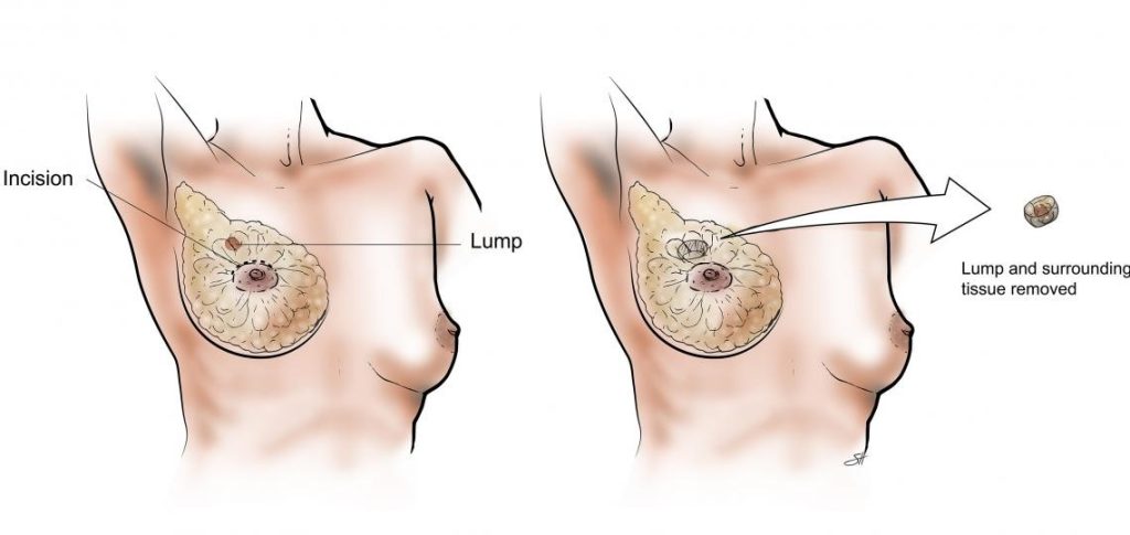 2Lumpectomy