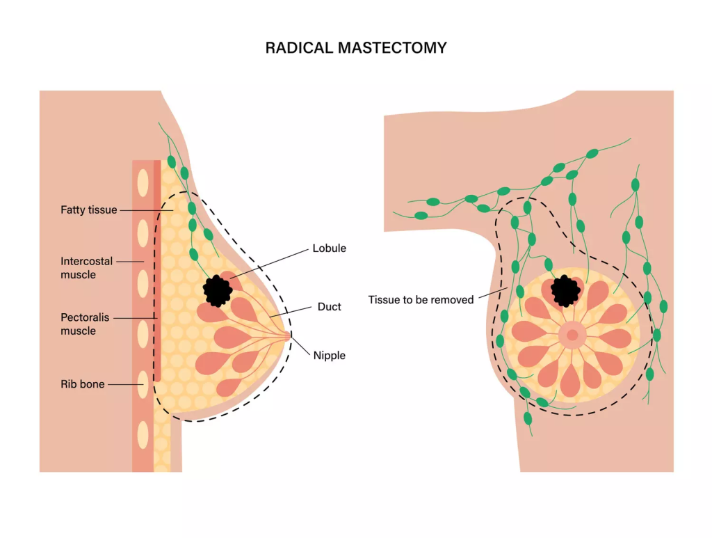 2Mastectomy