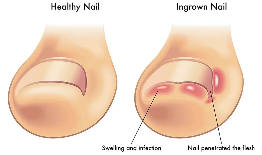Ingrown Toenail Surgery2