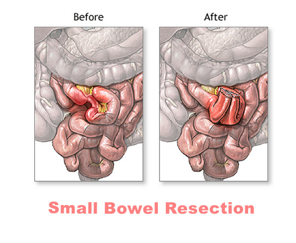 small bowel