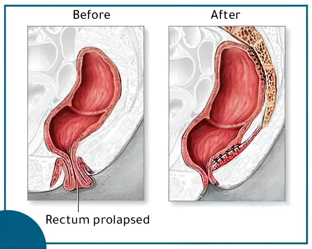 Rectal Prolapse